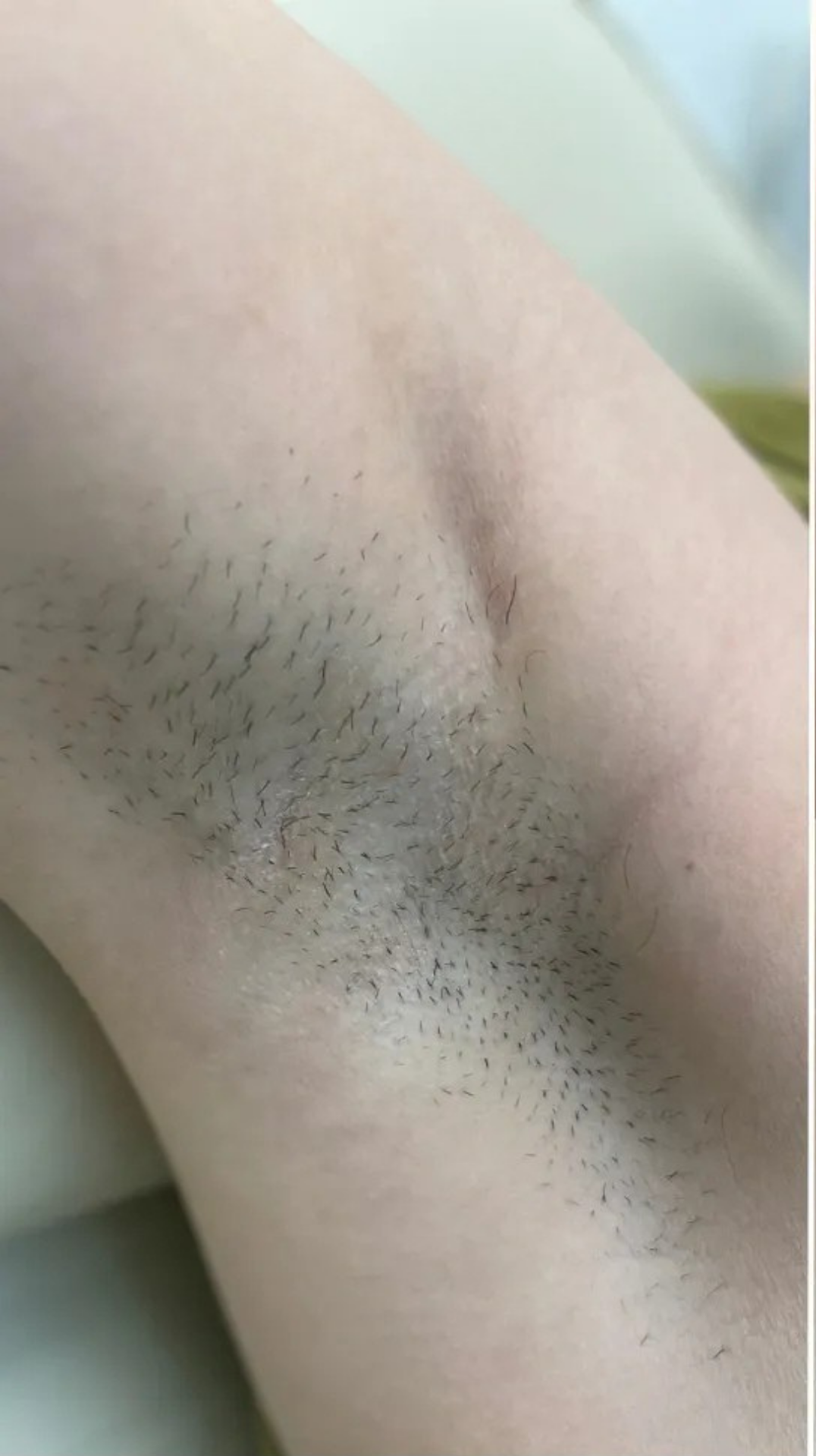 Dopo epilazione laser