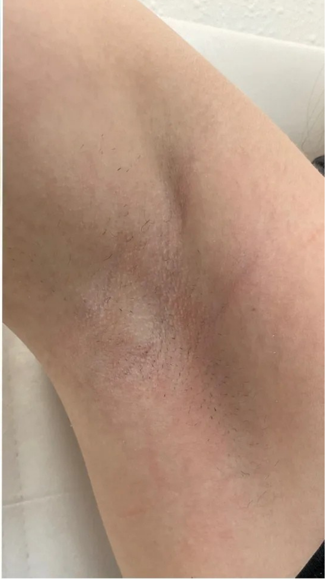 Prima epilazione laser